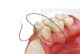 SUTURE IN POLIESTERE NON RIASSORBIBILI